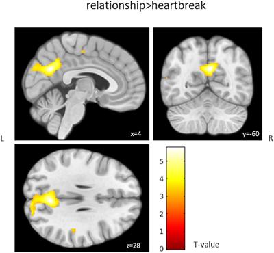 Working Memory Alterations After a Romantic Relationship Breakup